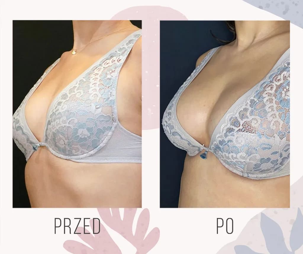 Naturalne powiększanie piersi - skuteczne metody i opinie z forum Naturalne powiększanie piersi - skuteczne metody i opinie z forum